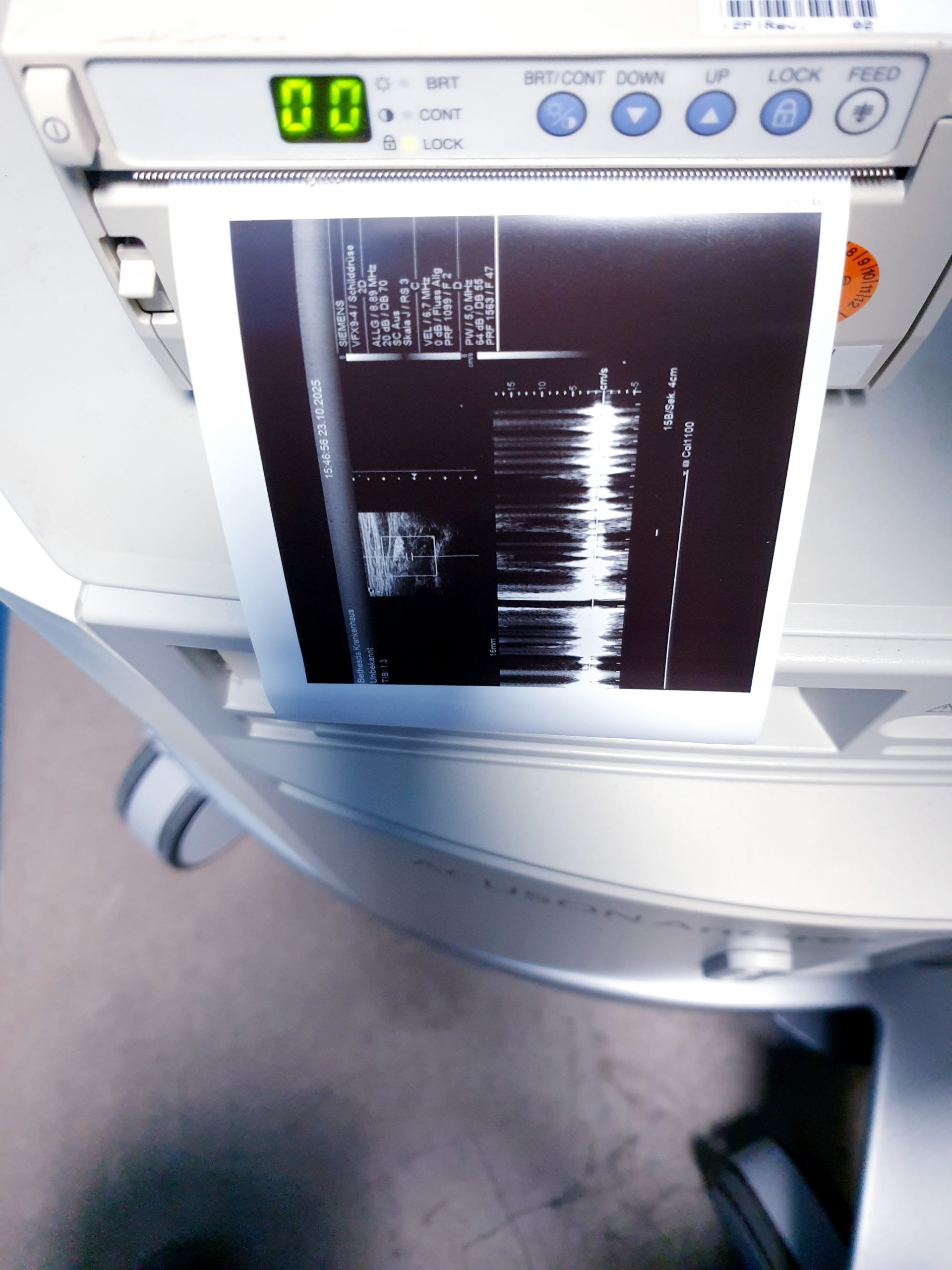 Siemens Acuson Antares Ultraschall Gerät mit 3 Sonden CH4-1 + PX4-1 + VFX9-4 – Bild 6