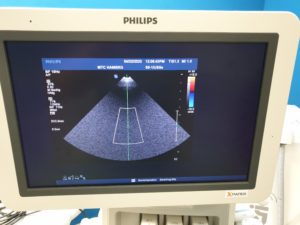 Philips S5-1 Echosonde  Sektor Ultraschallsonde