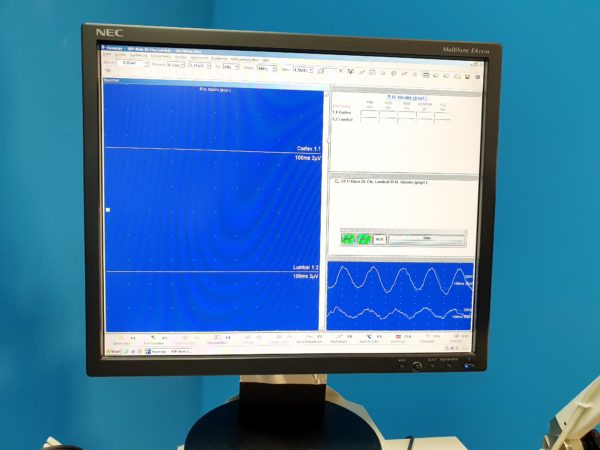 Toennies Viasys Medelec Synergy Neuroscreen EMG