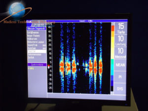 NICOLET Pioneer TC2020 Doppler Waveform Analyzer